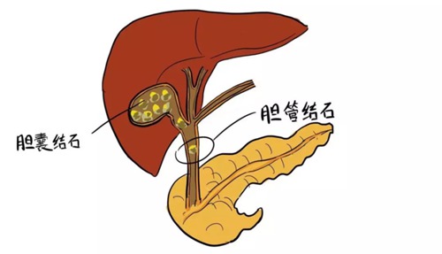 胆管梗阻有什么症状出现吗配图