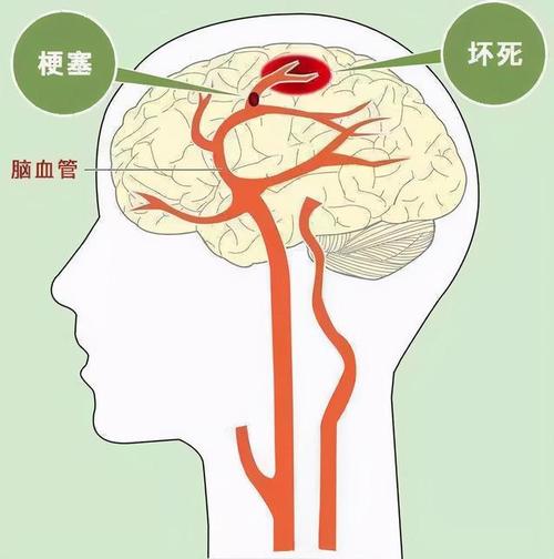 多发性脑梗应该注意些什么配图