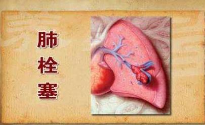 肺梗是什么病?配图