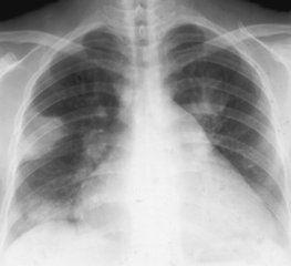 肺结梗是什么意思配图