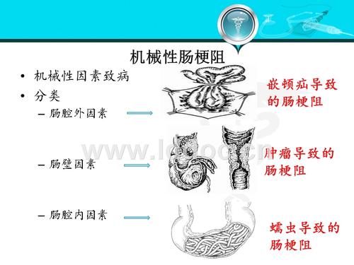 非机械性梗阻是什么意思配图