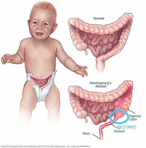 刚出生的宝宝肠梗阻是什么原因配图