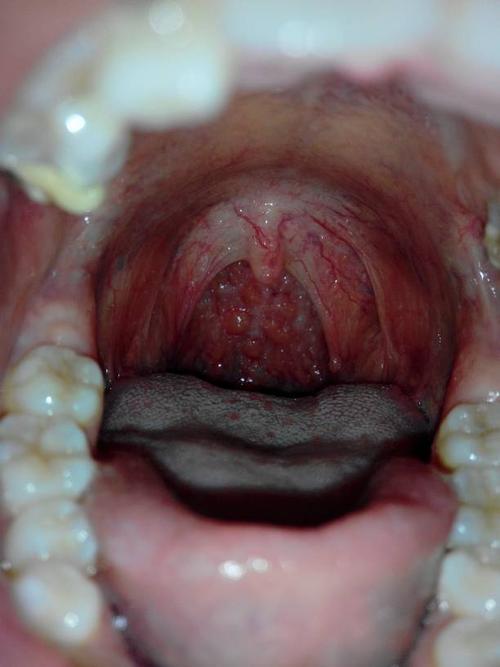 喉咙有梗塞感是什么原因有一点点恶心配图
