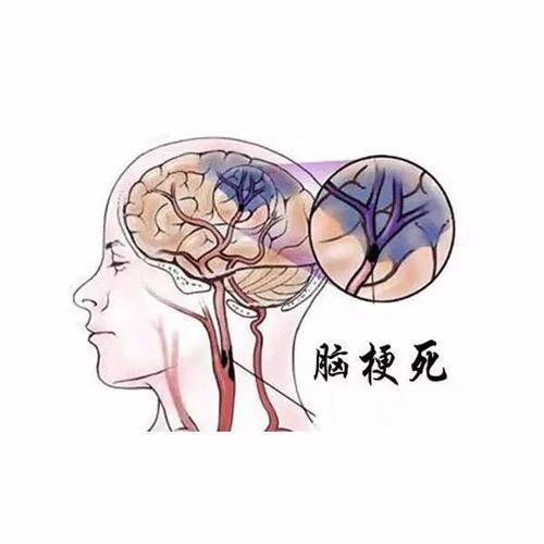 急性脑梗什么症状配图