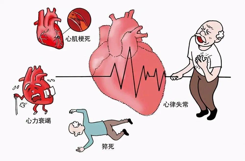 急性心梗主要是什么原因造成的配图
