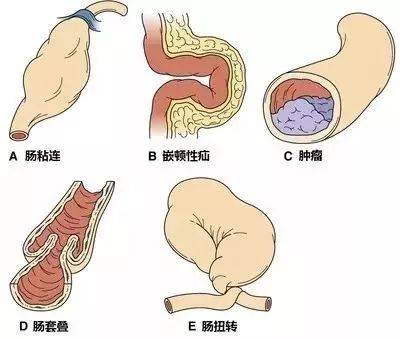 老年人易发生什么肠梗阻配图