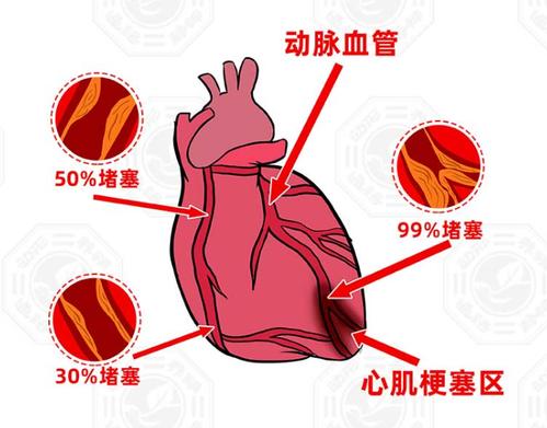 老年心梗是什么病呢严重不配图