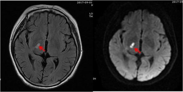 两侧放射冠腔隙性脑梗塞是什么意思配图
