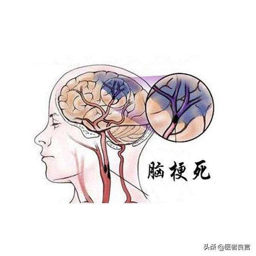 脑部梗塞什么症状配图