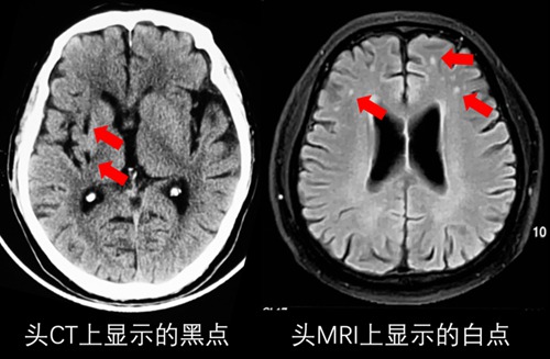 脑部缺血梗死灶是什么意思配图