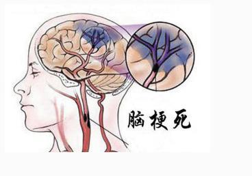 脑梗的症状是什么原因引起的配图