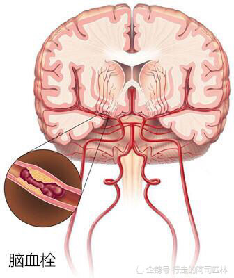 脑梗和堵塞有什么区别配图