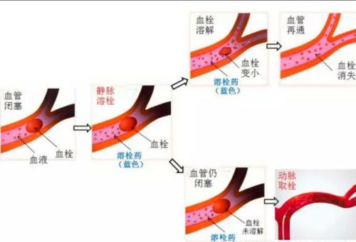 脑梗融酸治疗是什么配图