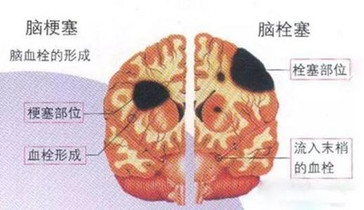 脑梗为什么会有后遗症配图