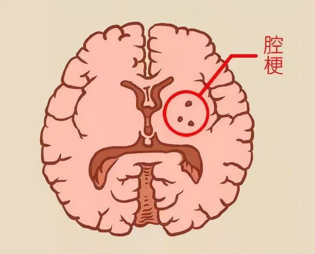 脑梗引起脑萎缩会导致什么后果配图