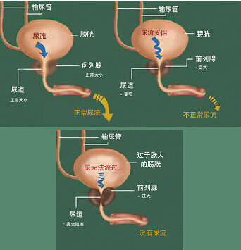 尿道功能性梗阻是什么意思配图