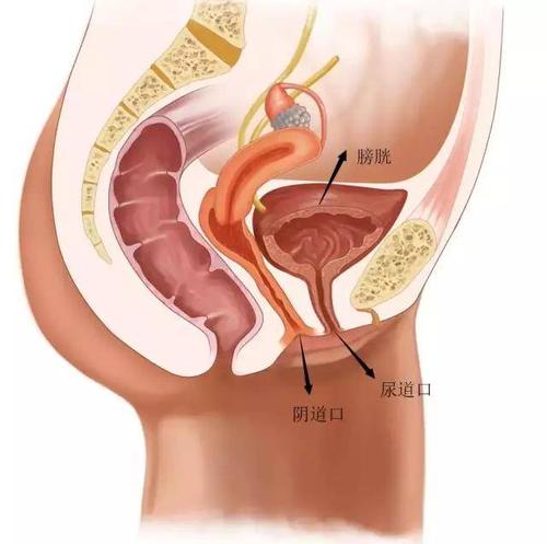 女性膀胱颈梗阻是什么症状配图