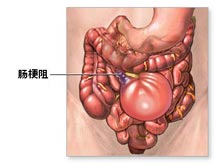 女性肠梗阻的症状吃什么药配图