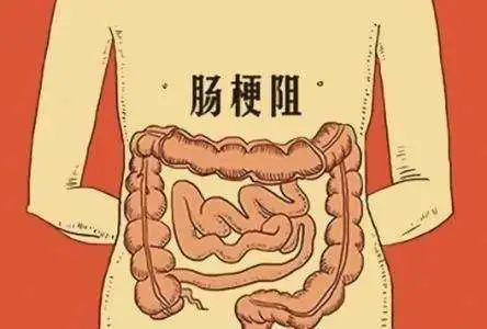 呕吐物为粪样的是什么肠梗阻配图