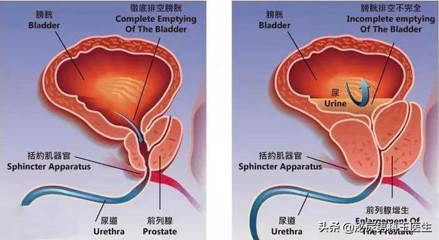 前列腺增生能引起什么梗阻配图