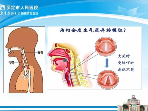 气道异物梗阻是什么手势配图