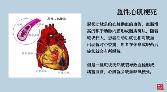 什么人会得心肌梗死配图