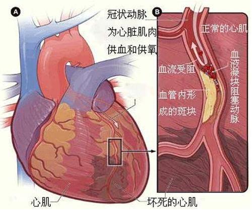 什么是急性心肌梗配图