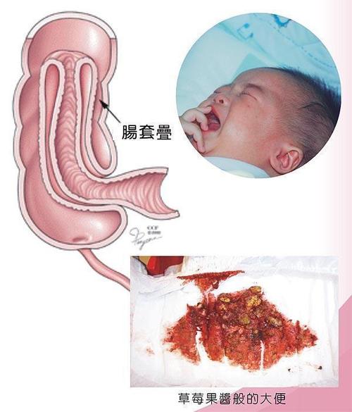 什么是婴儿肠梗阻配图