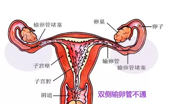 双侧输卵管不全梗阻是什么意思