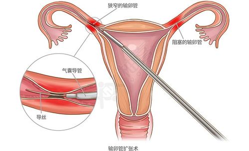 输卵管远端梗阻是什么原因造成的配图