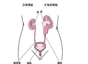 输尿管梗阻有什么症状婴儿配图