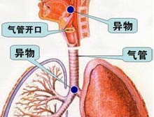 为什么呼气性呼吸困难见于下气道梗阻配图