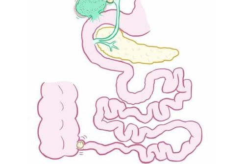 小肠梗阻呕吐物特点是什么配图
