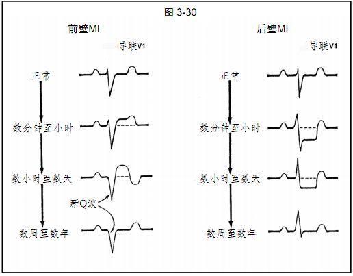 心电图显示下壁梗塞是什么意思配图