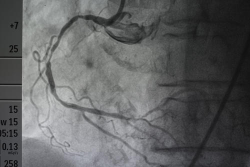 心梗造影是什么手术配图