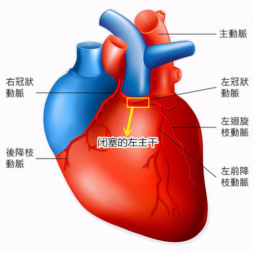 心脏下壁梗塞是什么原因呢配图