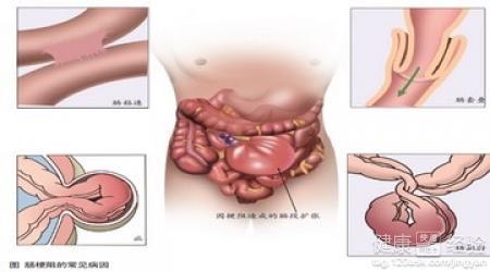 婴儿肠梗阻是什么原因配图
