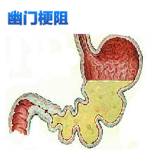 幽门梗阻改道手术什么意思