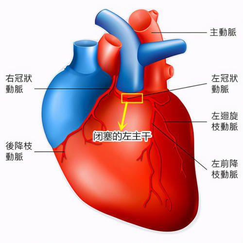 最严重的心梗是什么样的配图