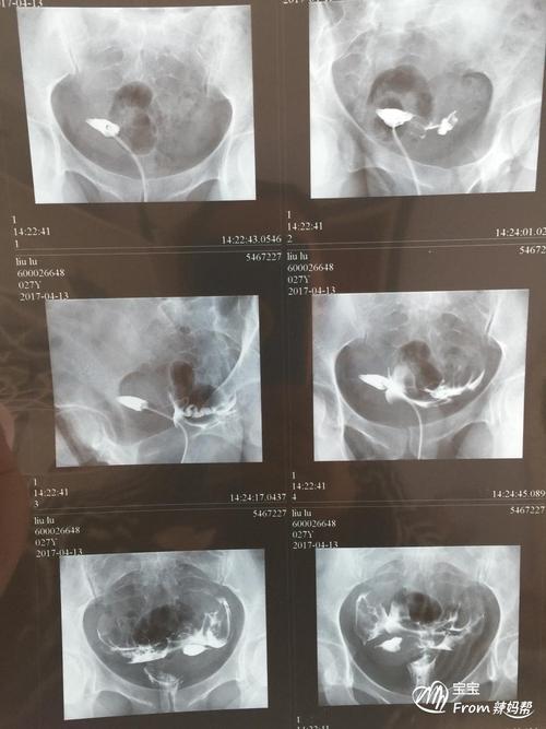左侧输卵管壶腹部梗阻是什么意思右侧通而不畅配图